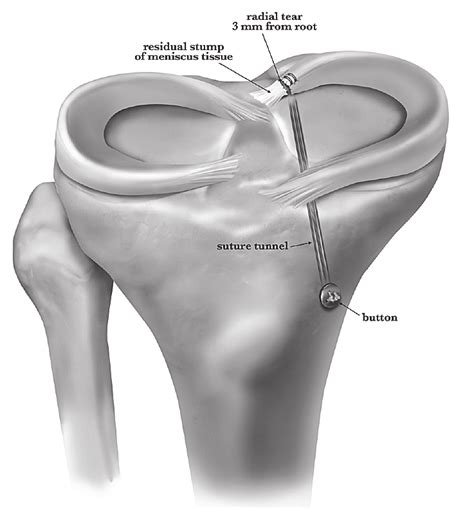 Posterior Horn Medial Meniscus Anatomy | Images and Photos finder