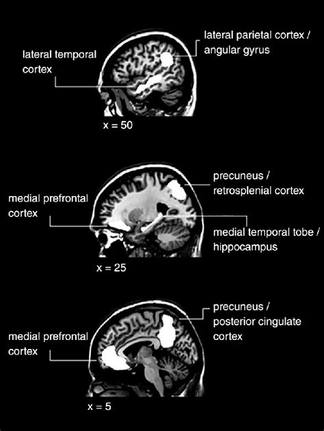 3 Network of common brain regions involved in memory recollection ...