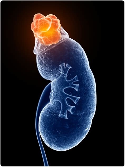 Adrenal Gland Tumor Symptoms