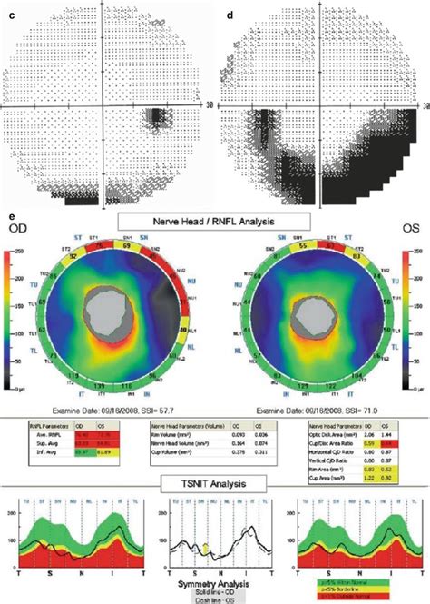 Digital Imaging of the Optic Nerve | Ento Key