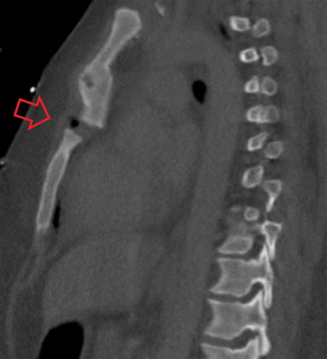 Sternum Location