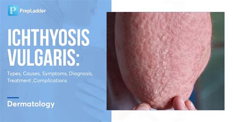 Ichthyosis Vulgaris: Types, Causes, Symptoms, Diagnosis, Treatment ...