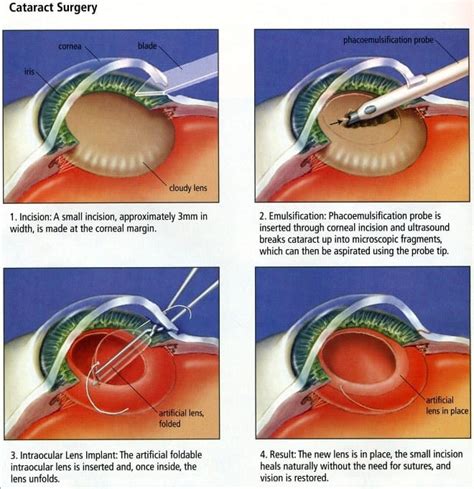 Free Cataract Surgery 2024 - Nance Anne-Marie