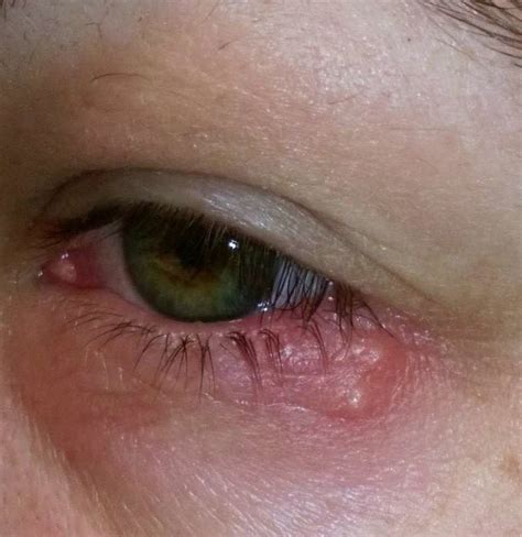 Eye herpes: Pictures, symptoms, and types