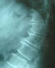 Cervical Spondylosis: Symptoms, Diagnosis and Treatment - Symptoma®