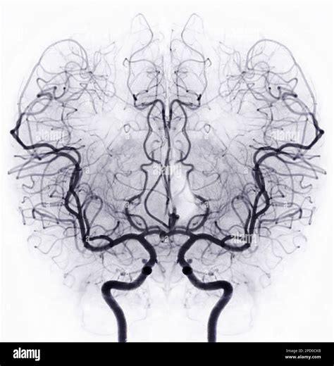 Cerebral angiography image from Fluoroscopy in intervention radiology showing cerebral artery ...