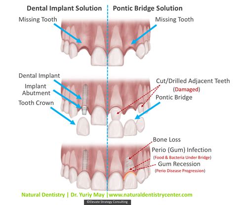 Dental Implant Dentist | Implant Surgery
