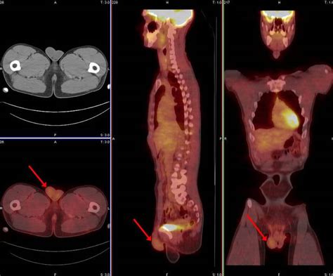 PET/CT