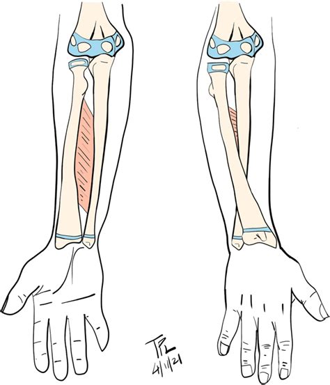 Interosseous membrane is a stabilizer of both forearm bones. The radius... | Download Scientific ...