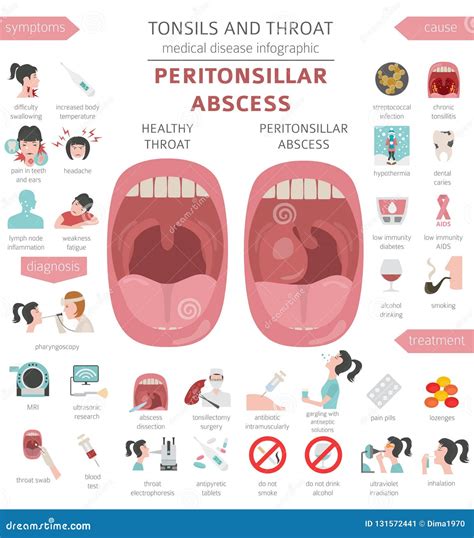 Tonsils and Throat Diseases. Peritonsillar Abscess Symptoms, Treatment Icon Set. Medical ...