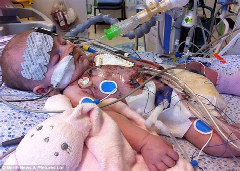 Youngest ever baby to undergo open heart surgery goes home for the first time | Daily Mail Online