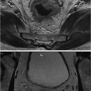 (PDF) Extramural venous invasion is a potential imaging predictive ...