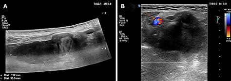 Subcutaneous Hematoma Ultrasound