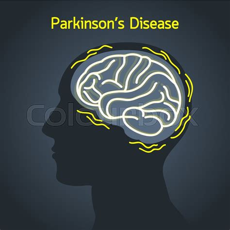 Parkinson’s disease vector logo icon ... | Stock vector | Colourbox