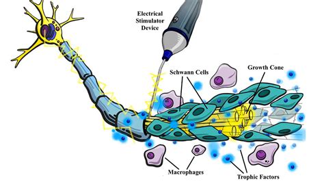 Newly invented electrical stimulation (ES) device improves nerve regeneration in humans | Ohio ...