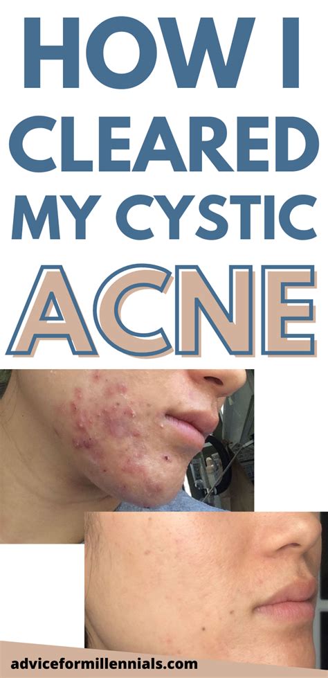 How I Cleared My Cystic Acne WITHOUT Accutane | Hormonal acne treatment, Bad acne, Cystic acne ...