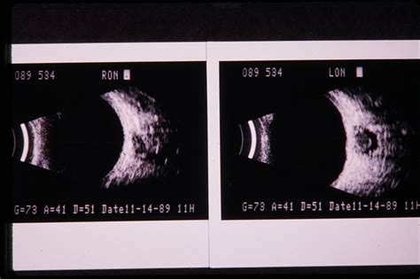 Optic Nerve Meningioma - Retina Image Bank