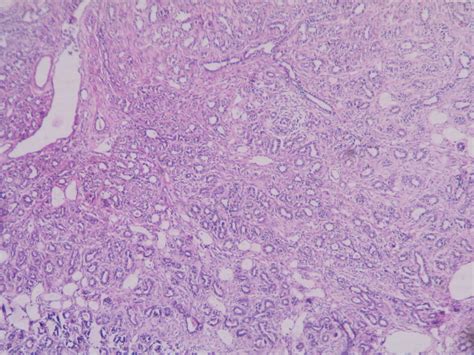 Tubular adenoma – Histopathology.guru