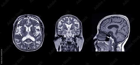 Stockfoto Comparison MRI of the brain Axial, Coronal , sagittal plane ...