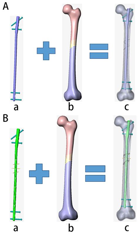 Intramedullary Nailing Femur Recovery - Nail Ftempo