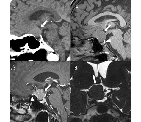 Tuberculum sellae meningioma (meningothelial meningioma). An ...