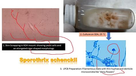 Sporothrix: Introduction, Morphology, Pathogenesis, Complications, Labo