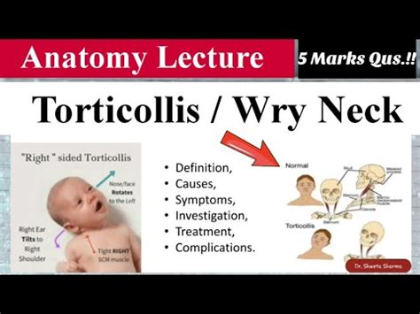 Torticollis/ Wry Neck- Anatomy Lecture| Dr.Shweta Sharma - YouTube