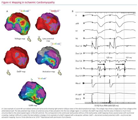 Mapping in Ischaemic Cardiomyopathy | USC Journal