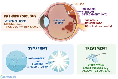 Surgical Fixation of the Retina Medical Term - SorenkruwCollins