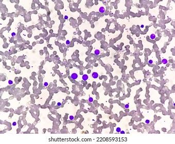 Chronic Myelogenous Leukemia Cml Known Chronic Stock Photo 2208593153 | Shutterstock