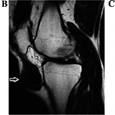 Tendinous xanthoma of the EDC | Download Scientific Diagram