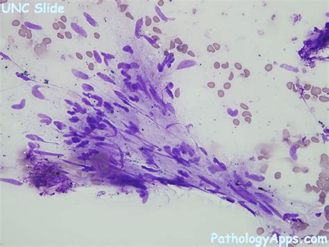 fibrosarcoma soft tissue cytology