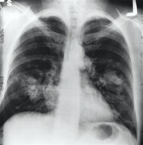 What Are Top Causes of Lung Cancer? - HealthMed.org