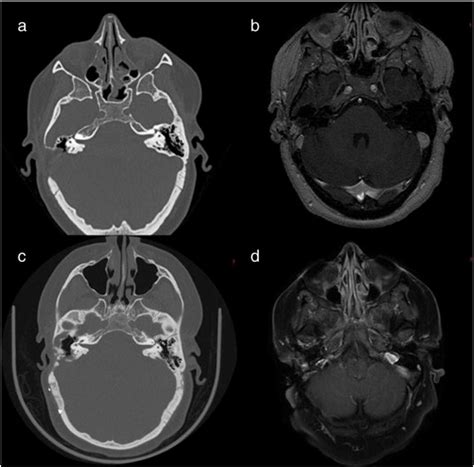 (a & b) CT temporal bone and MRI with contrast images at the time of... | Download Scientific ...