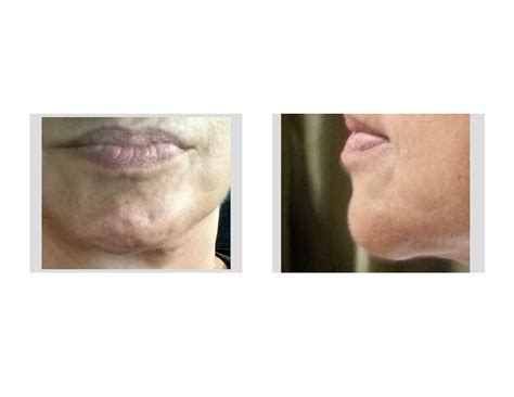 Plastic Surgery Case Study - Female Chin Implant Revision - Explore ...