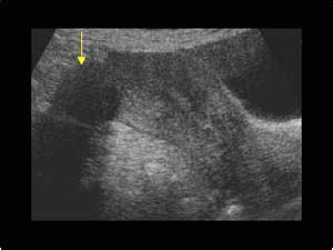 WK 3 L 2 Subserosal fibroid with a hypoechoic mass projecting from the peritoneal surface of the ...