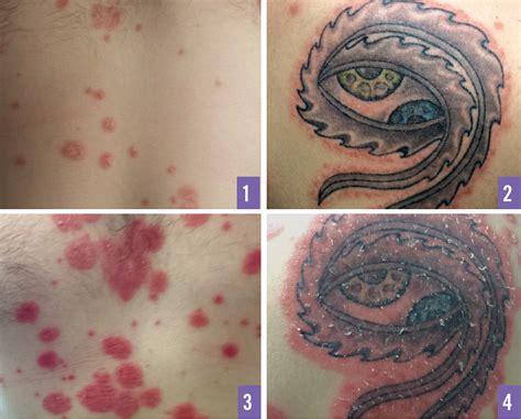 Details more than 58 psoriasis and tattoos latest - in.cdgdbentre