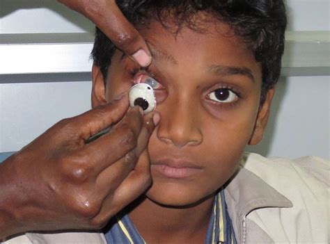 Prosthetic Eye (Artificial eye) - Aravind Eye Care System