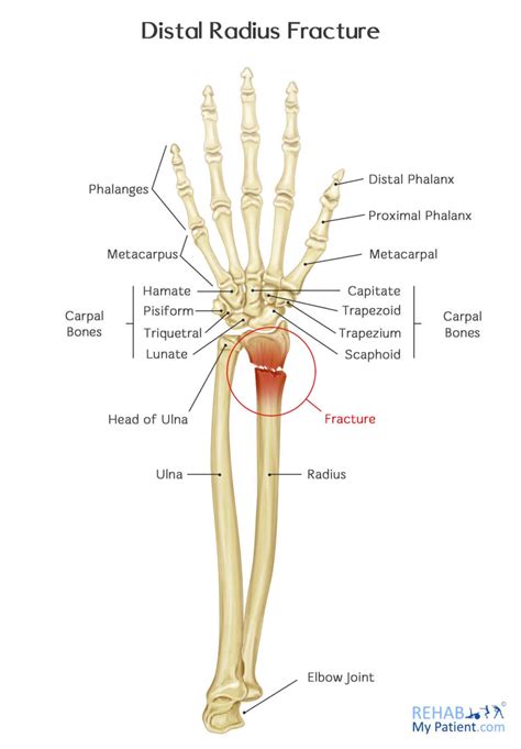 Distal Radius Fracture | Rehab My Patient