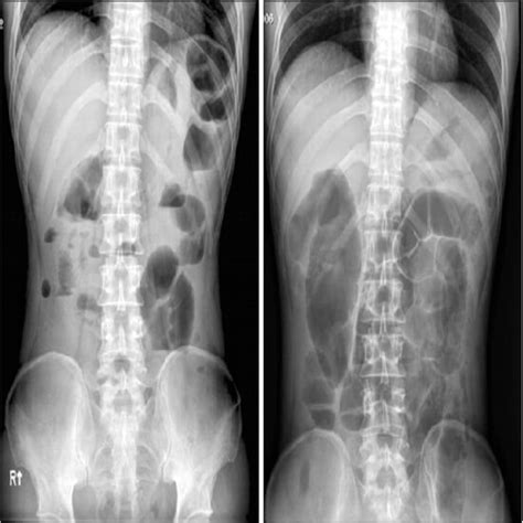 X-Ray Abdomen (Erect & Supine) | Test Price in Delhi | Ganesh Diagnostic