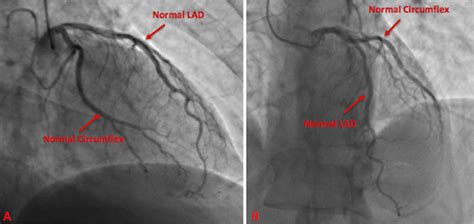 Cureus | Vasospastic Angina and Role of Cardiac Catheterization