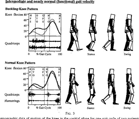 [PDF] Gait Pattern in the Early Recovery Period after Stroke ...