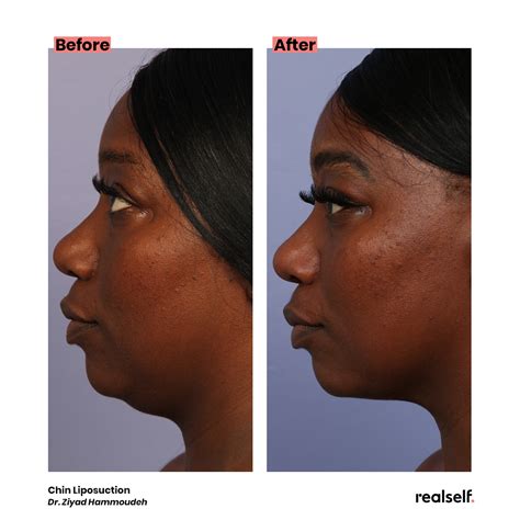 under chin lipo before and after