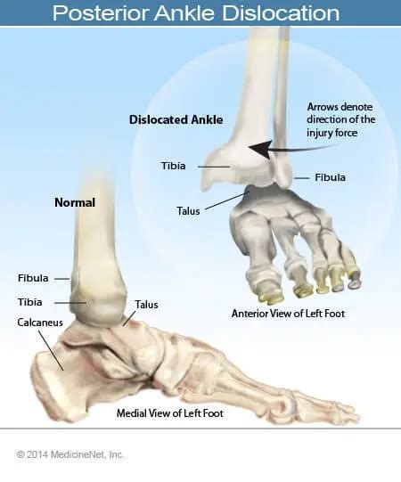 Dislocated Ankle: Symptoms, Treatment, Recovery, and Surgery