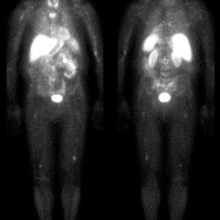 legend: The image on the left is a MIBI scan that demonstrates high... | Download Scientific Diagram