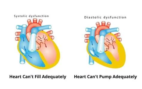 Systolic Heart Failure vs Diastolic Heart Failure: Symptoms, Diagnosis, Treatment, and Prognosis ...