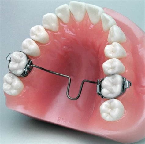 About the TPA Orthodontic Appliance - ArchWired