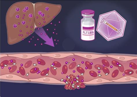 Hemophilia B Gene Therapy Shows Promise in Clinical Trial