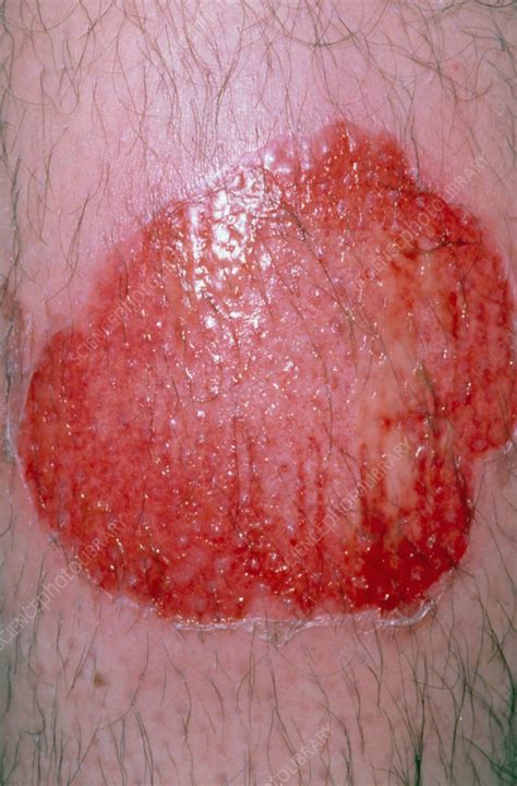 Close-up of infected leg burn from steam cleaner - Stock Image - M335/0099 - Science Photo Library