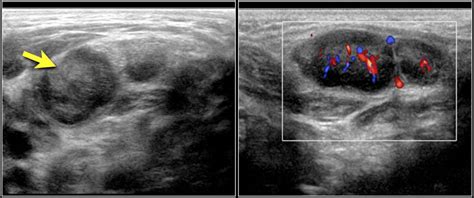 Supraclavicular Lymph Nodes Ultrasound - Ultrasound Of Superficial Lymph Nodes Sciencedirect ...